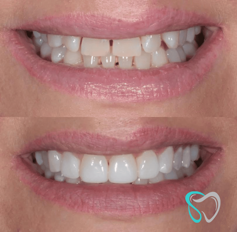 Before After - Smiles By Jasmine