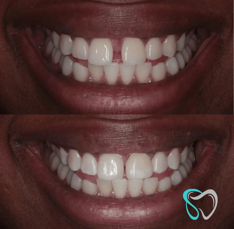 Before After - Smiles By Jasmine