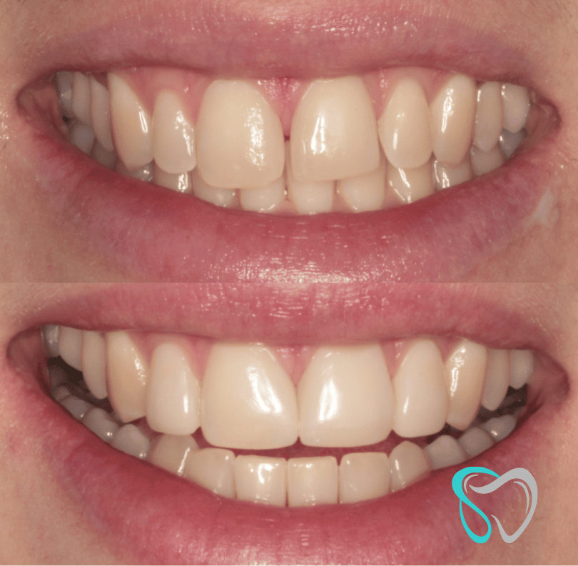 Before After - Smiles By Jasmine