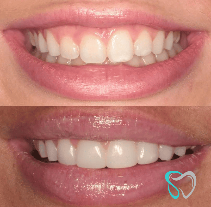 Before After - Smiles By Jasmine
