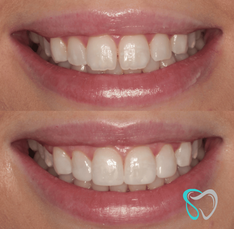 Before After - Smiles By Jasmine