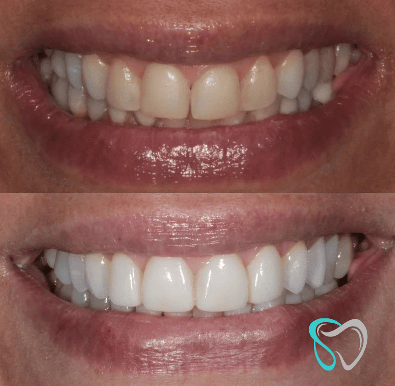 Before After - Smiles By Jasmine