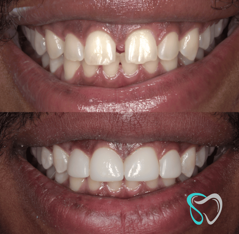 Before After - Smiles By Jasmine