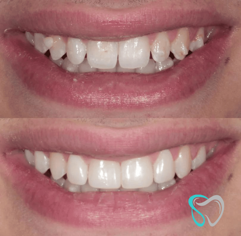 Before After - Smiles By Jasmine