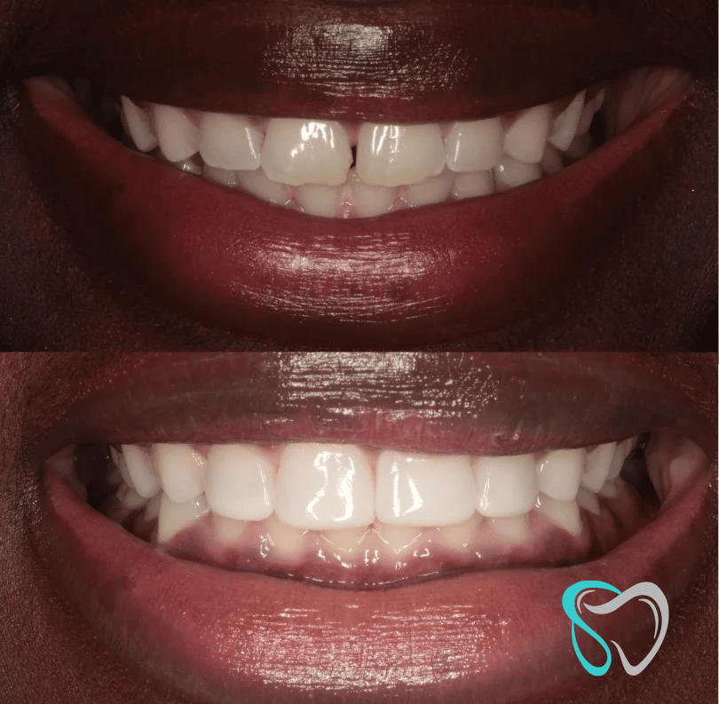 Before After - Smiles By Jasmine