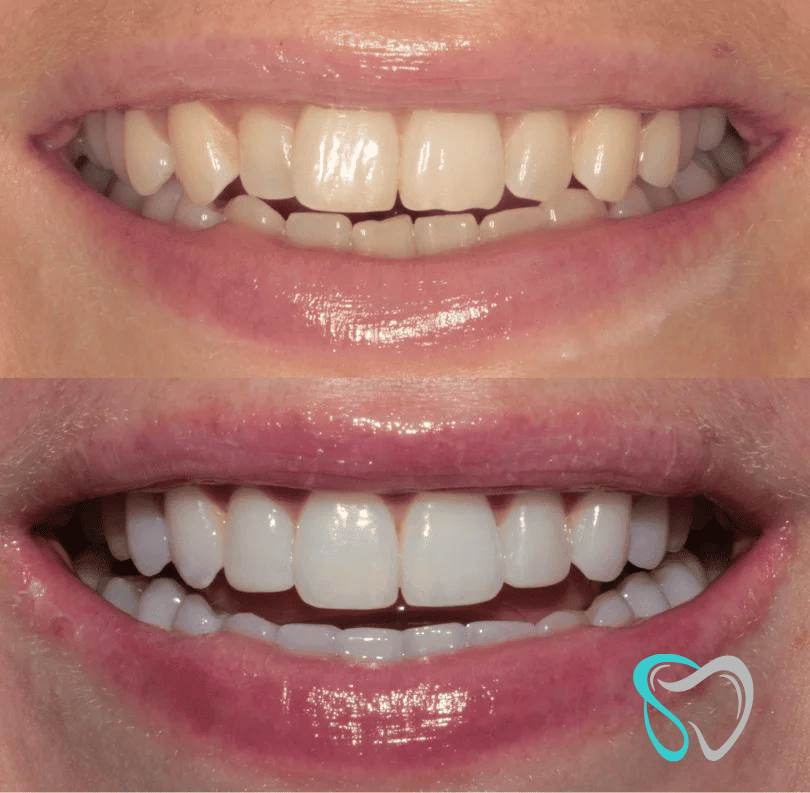 Before - smilesbyjasmine Dental New